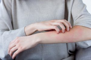 Alergijski svrab: Kako brzo i efikasno ublažiti neprijatne simptome?