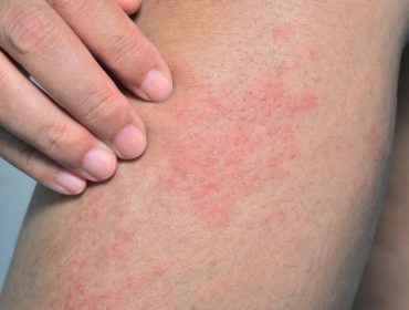 Atopijski dermatitis: Zašto se javlja crvenilo, upala i svrab tkiva?
