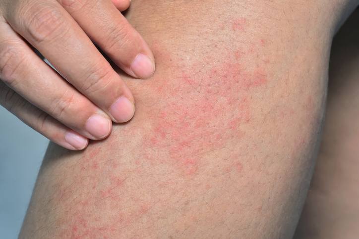 Atopijski dermatitis: Zašto se javlja crvenilo, upala i svrab tkiva?