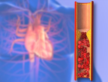 Da li znate koja je razlika između ateroskleroze i arterioskleroze?