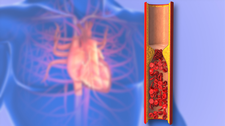 Da li znate koja je razlika između ateroskleroze i arterioskleroze?